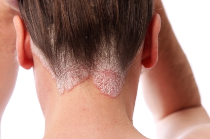 psoriasis on the hairline and on the scalp-close up